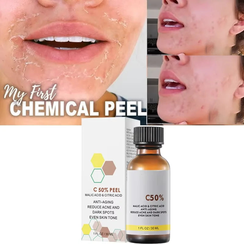 With Malic Acid And Citric Acid For Face Facial Peel 40% Peeling Serum Peeling Serum Chemical Peel Whitening Nourishing Essence